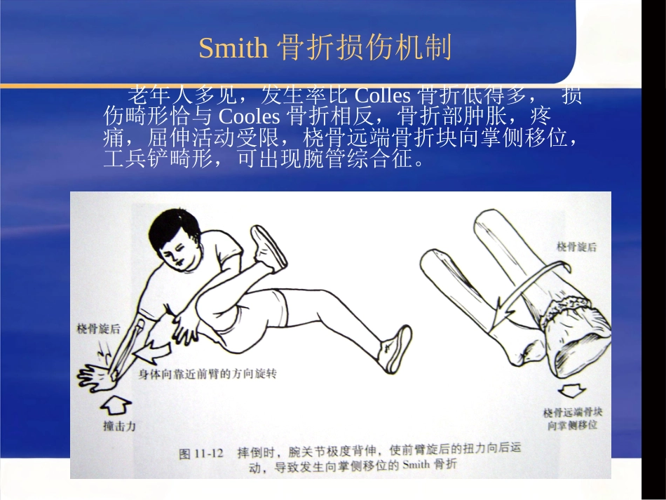 桡骨远端骨折治疗_第8页