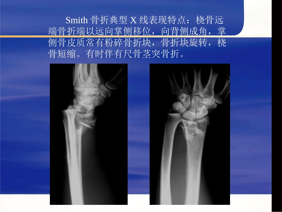 桡骨远端骨折治疗_第9页