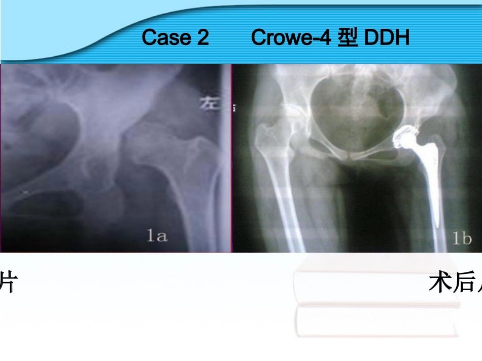 螺旋臼要点_第12页
