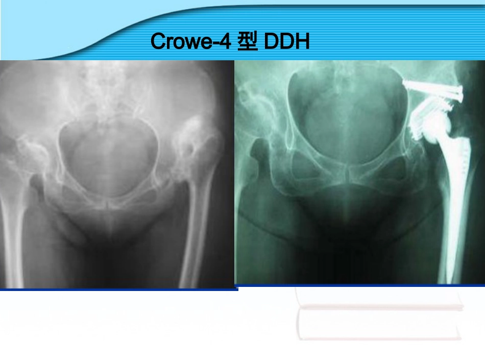 螺旋臼要点_第13页