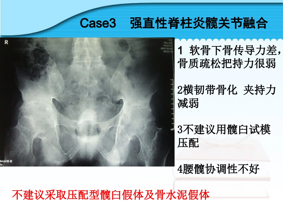 螺旋臼要点_第14页