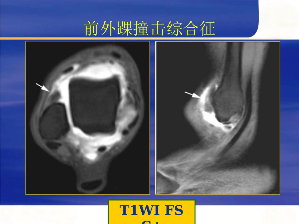 踝关节撞击综合征影像学_第10页
