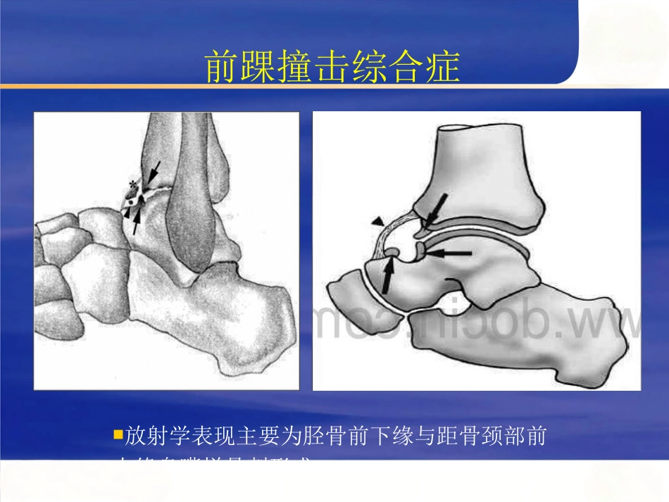 踝关节撞击综合征影像学_第14页