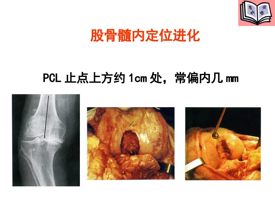 全膝关节置换的手术原则PPT_第15页