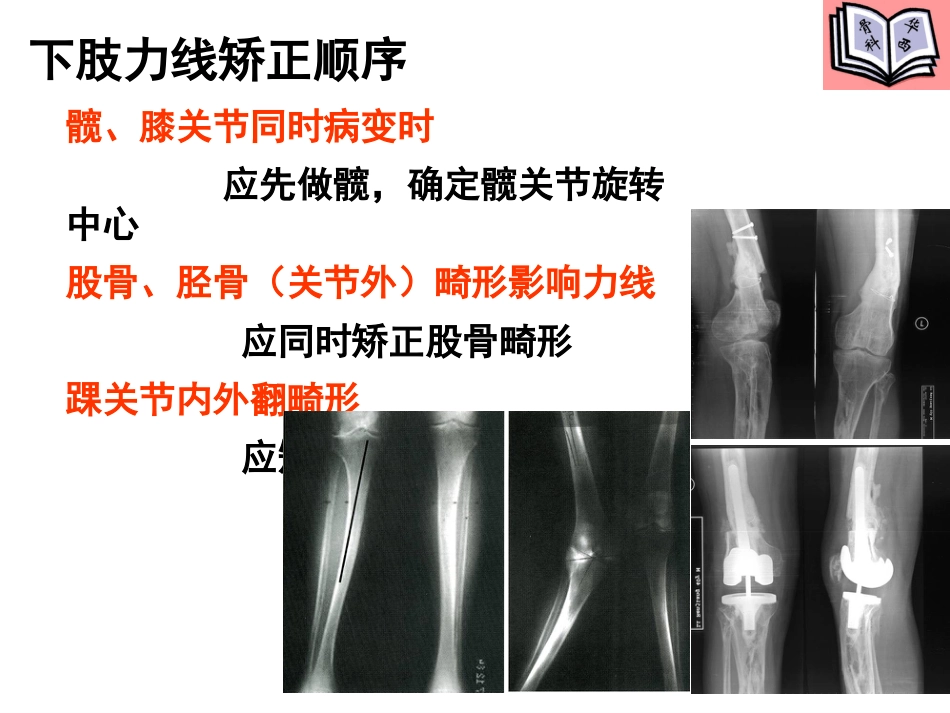 全膝关节置换的手术原则PPT_第8页