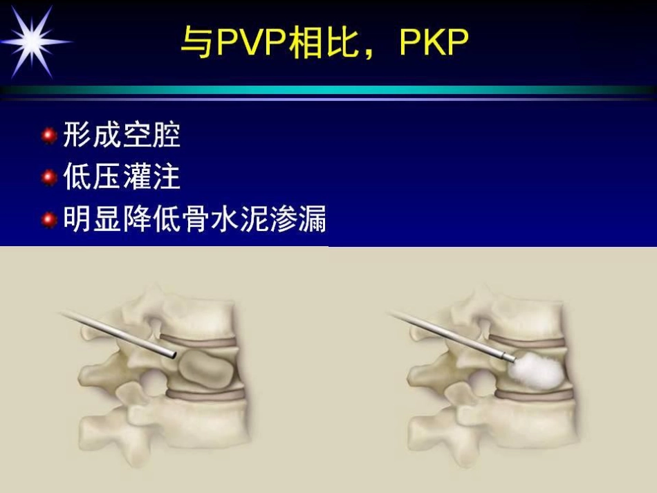如何防止椎体强化术中并发症_第10页