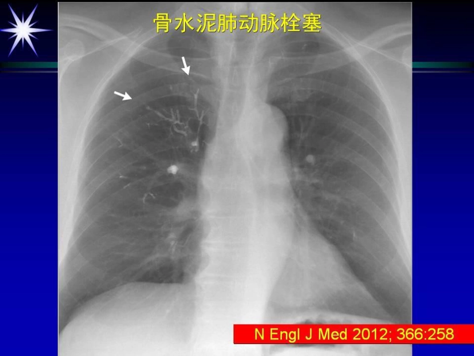 如何防止椎体强化术中并发症_第7页