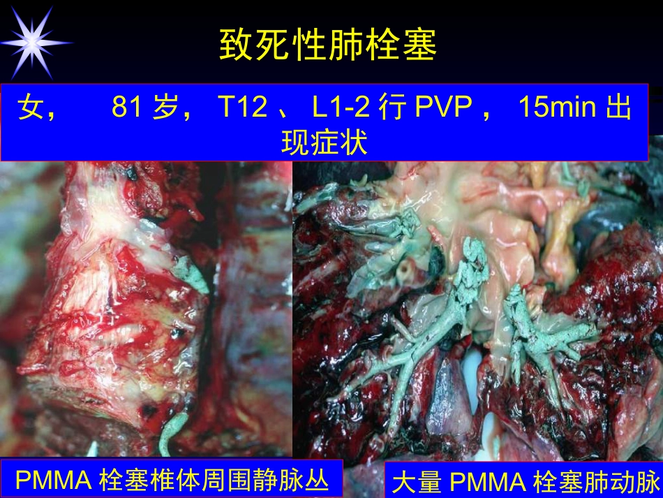 如何防止椎体强化术中并发症_第8页