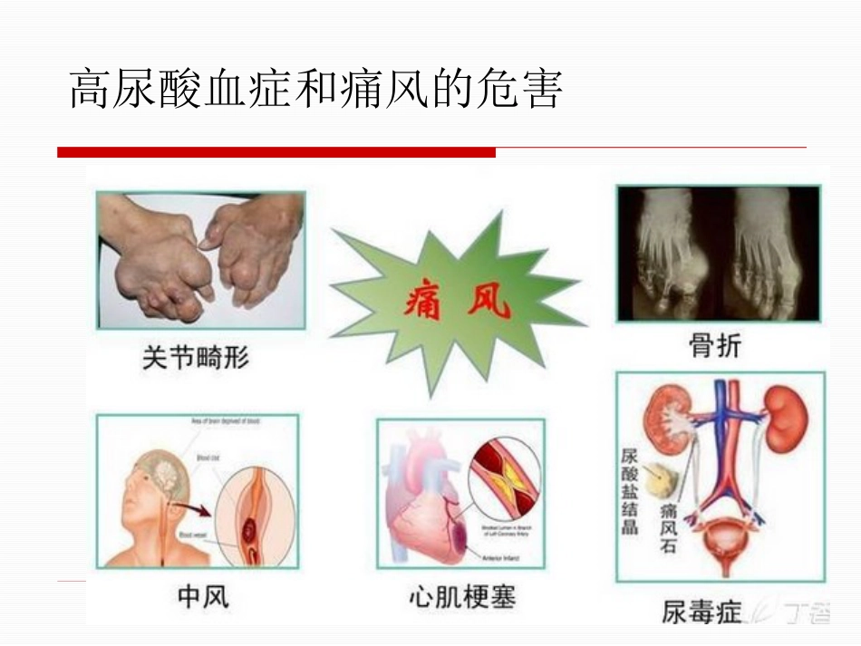 痛风性关节炎的规范化治疗_第5页