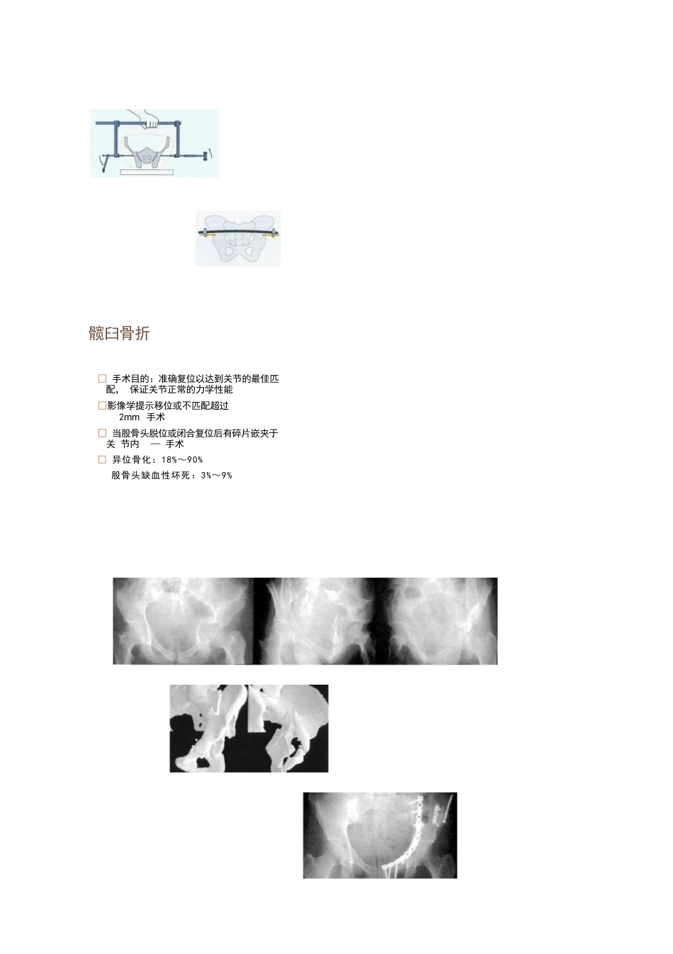 各部位骨折的手术时机选择_第8页