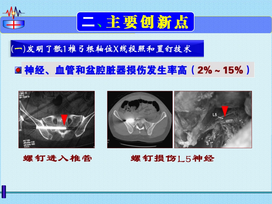 微创治疗骨盆髋臼 ZH骨折 弹性固定 锁骨复位器_第13页