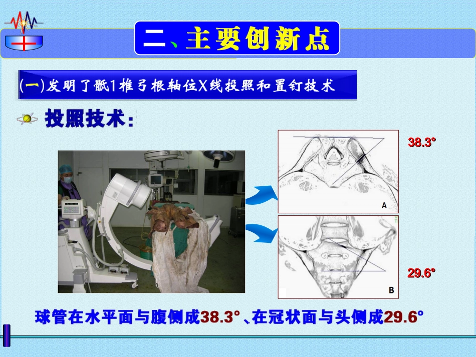 微创治疗骨盆髋臼 ZH骨折 弹性固定 锁骨复位器_第15页