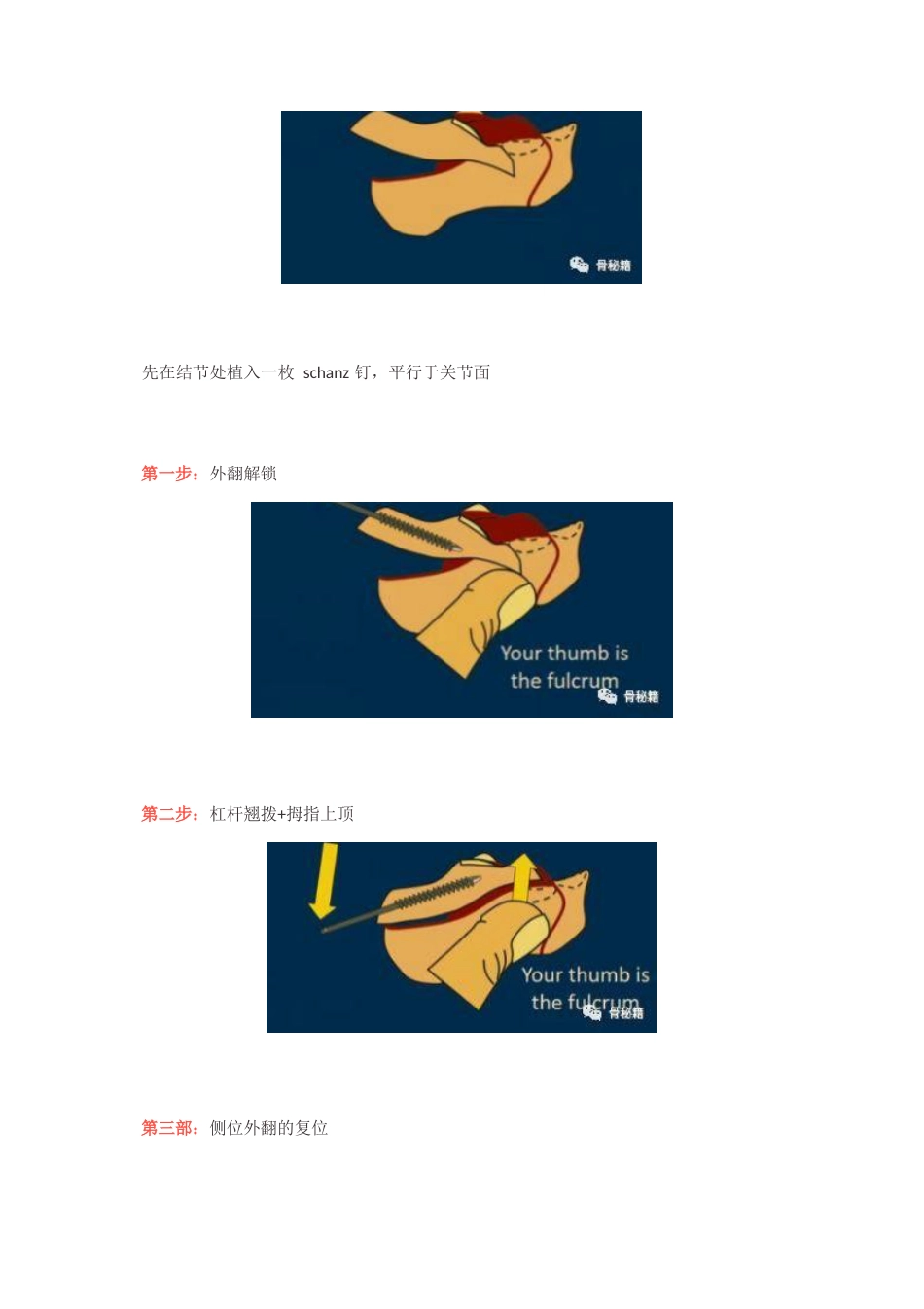 跟骨舌形骨折闭合复位技巧_第3页