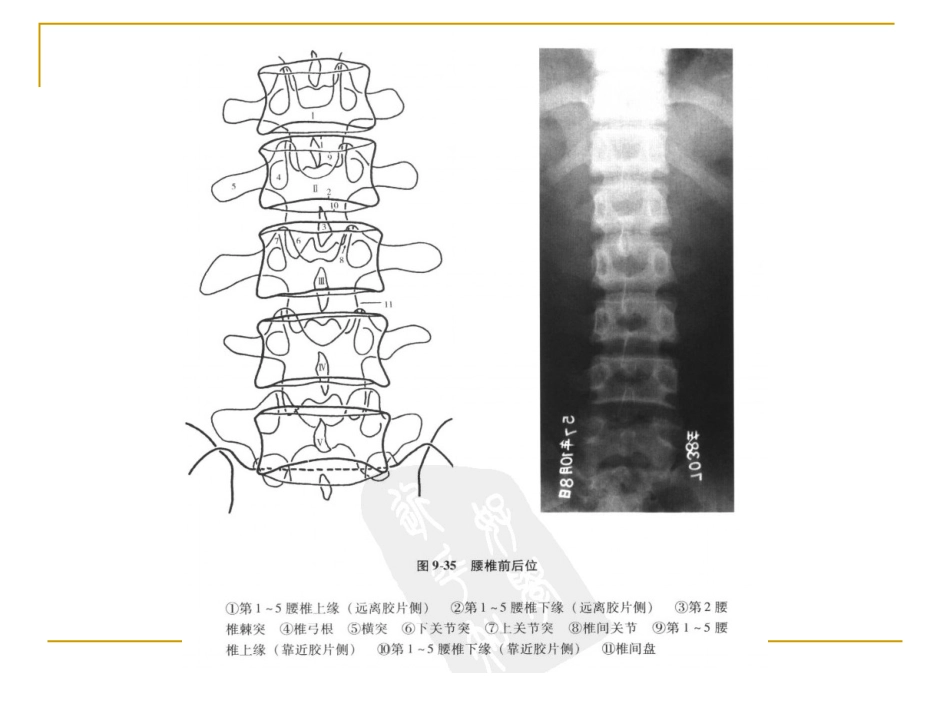 脊柱x片诊断_第11页