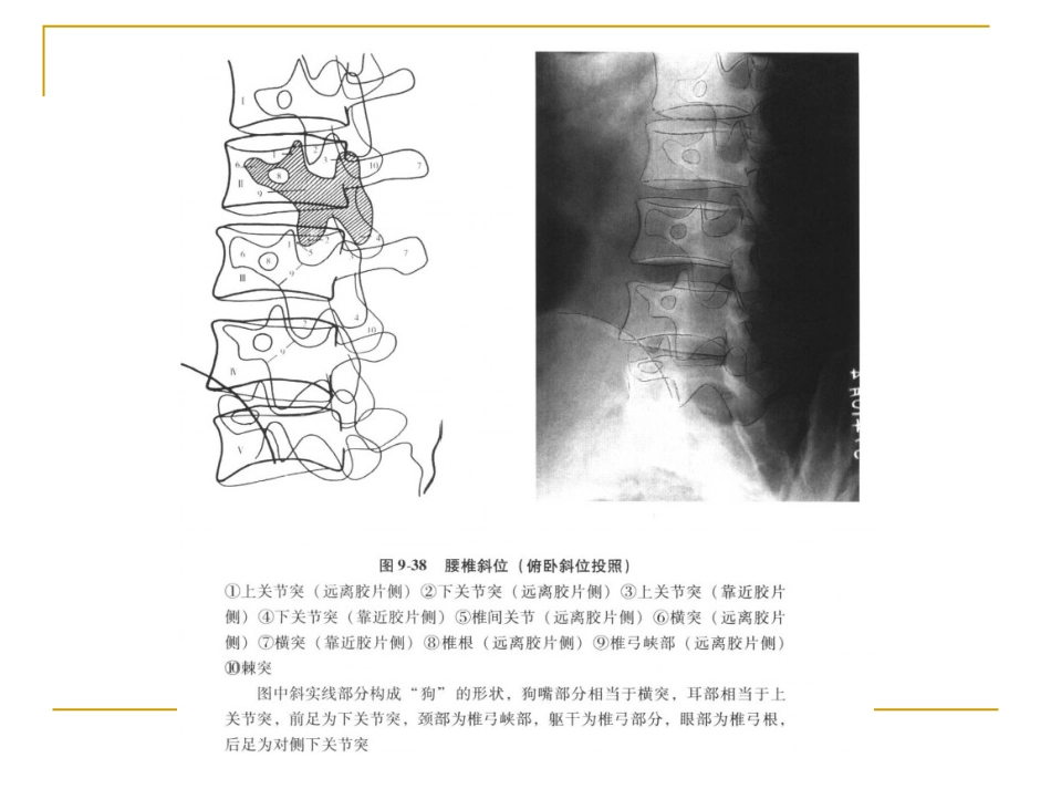 脊柱x片诊断_第13页