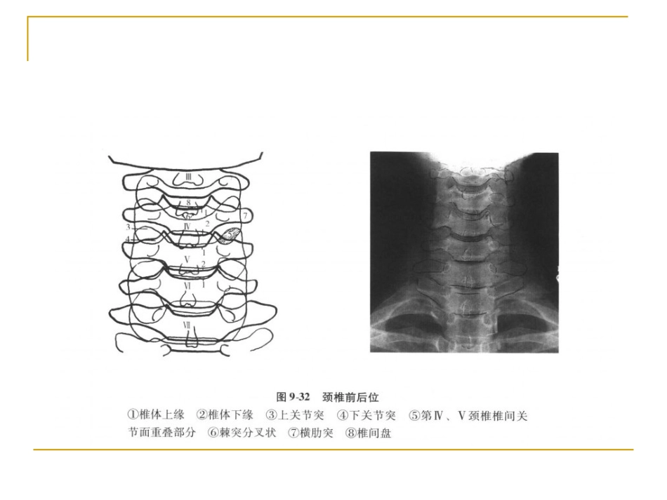脊柱x片诊断_第6页