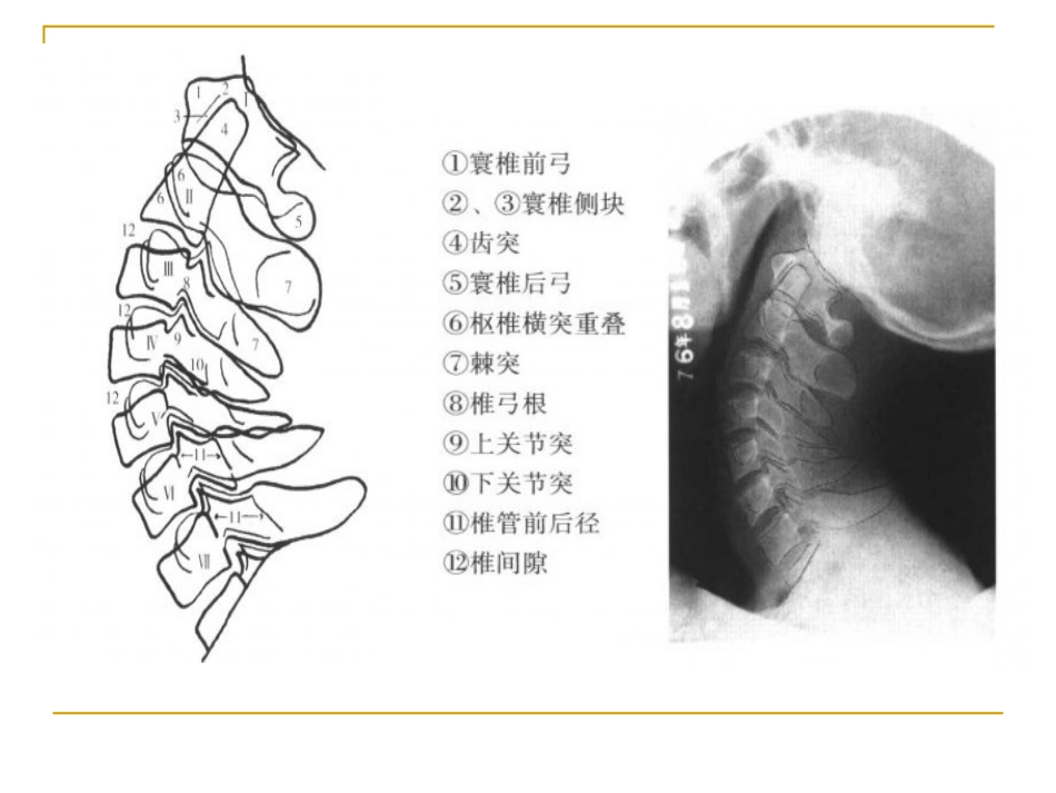 脊柱x片诊断_第7页