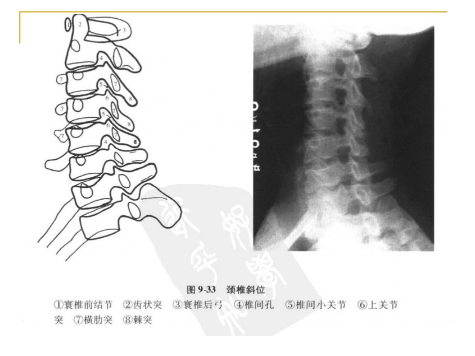 脊柱x片诊断_第8页
