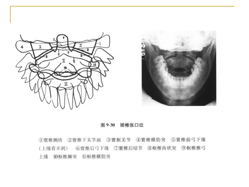 脊柱x片诊断_第9页
