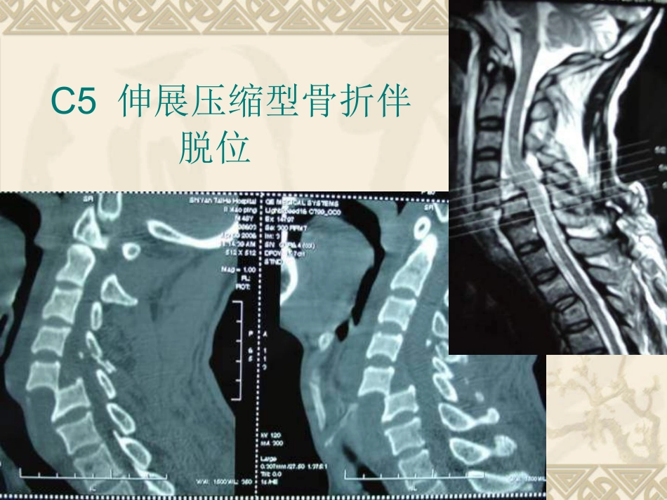 颈椎骨折脱位诊断与治疗_第13页