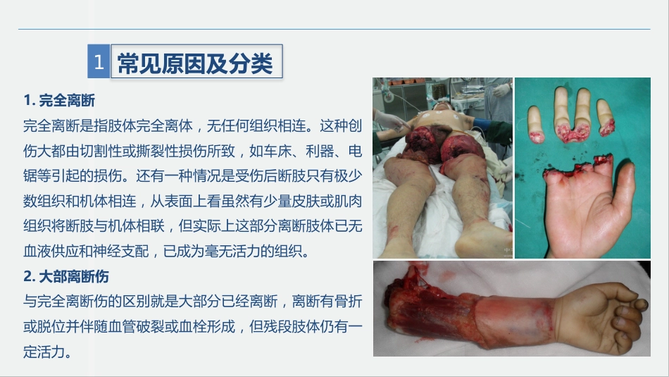 骨科-肢体离断伤的护理查房_第5页