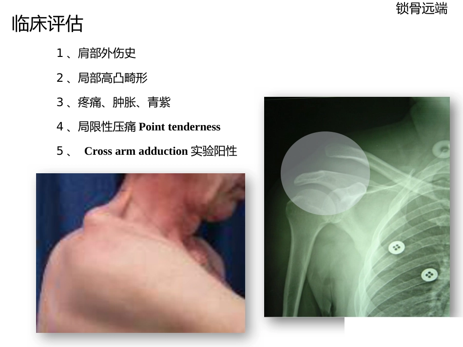 锁骨远端骨折_第11页