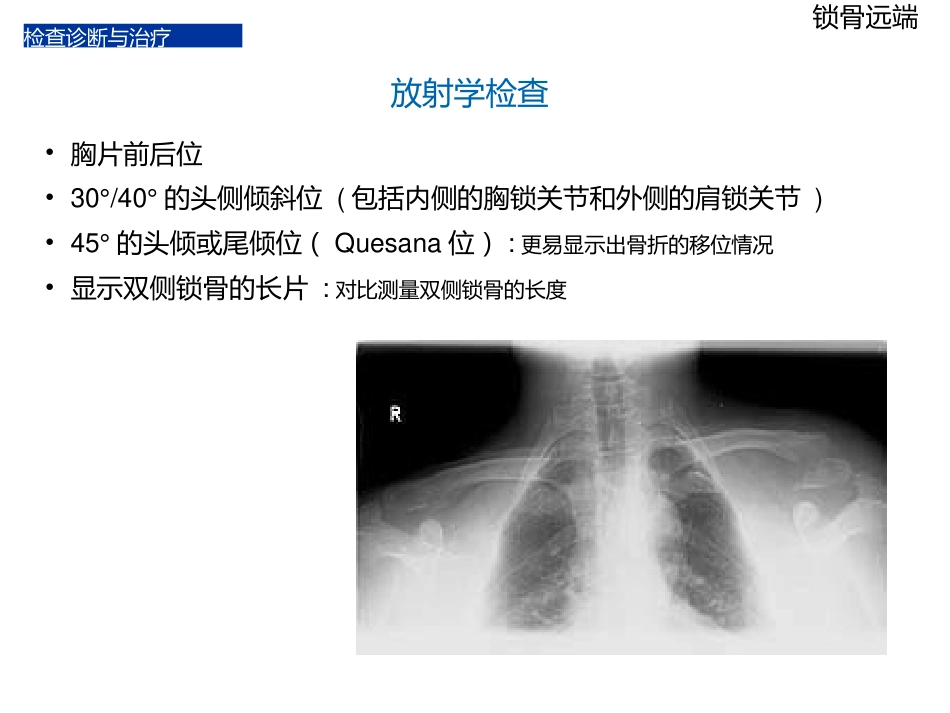 锁骨远端骨折_第12页