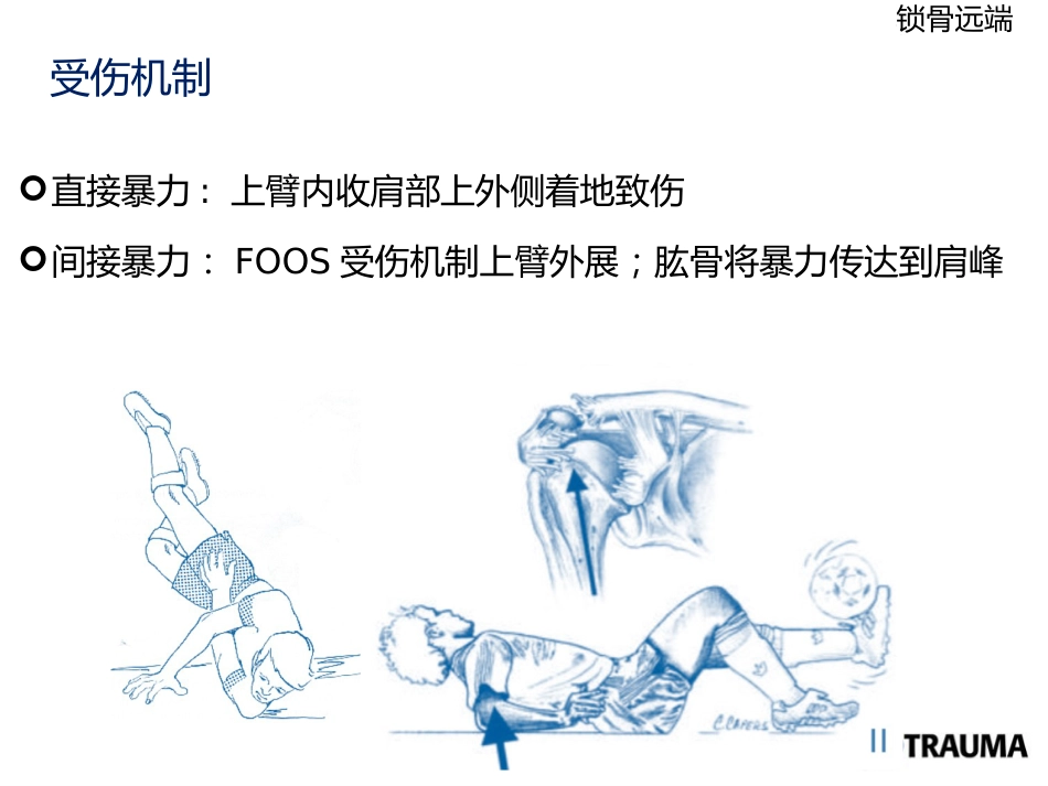 锁骨远端骨折_第3页