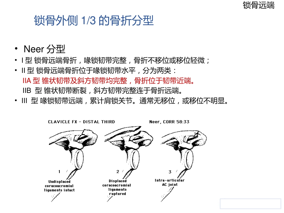 锁骨远端骨折_第6页