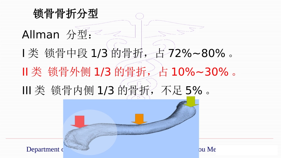 锁骨远端骨折伴肩锁关节脱位的治疗(yq)_第2页