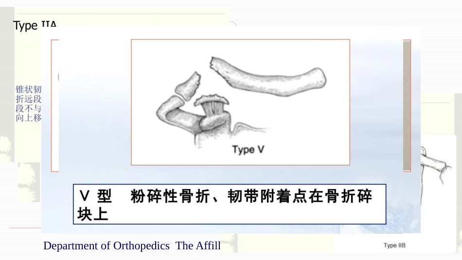 锁骨远端骨折伴肩锁关节脱位的治疗(yq)_第8页