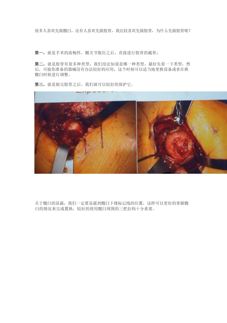 髋关节置换手术中如何做一个好的髋臼_第3页