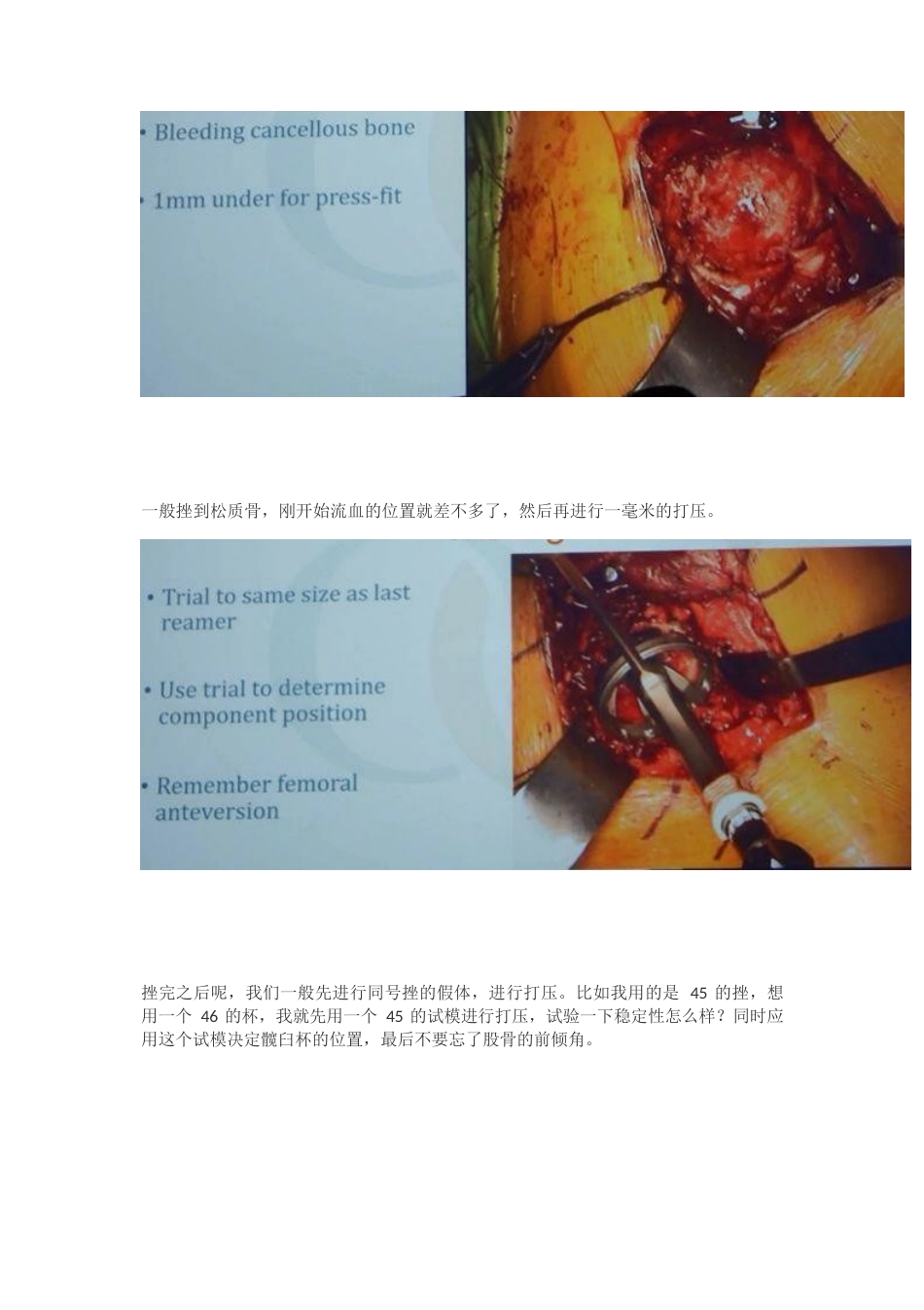 髋关节置换手术中如何做一个好的髋臼_第5页
