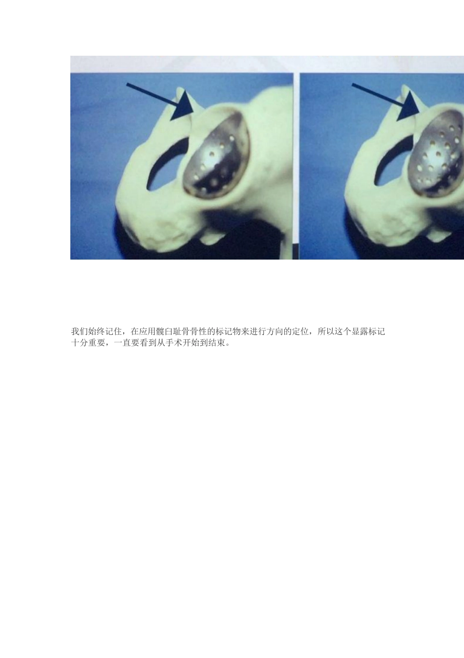 髋关节置换手术中如何做一个好的髋臼_第6页