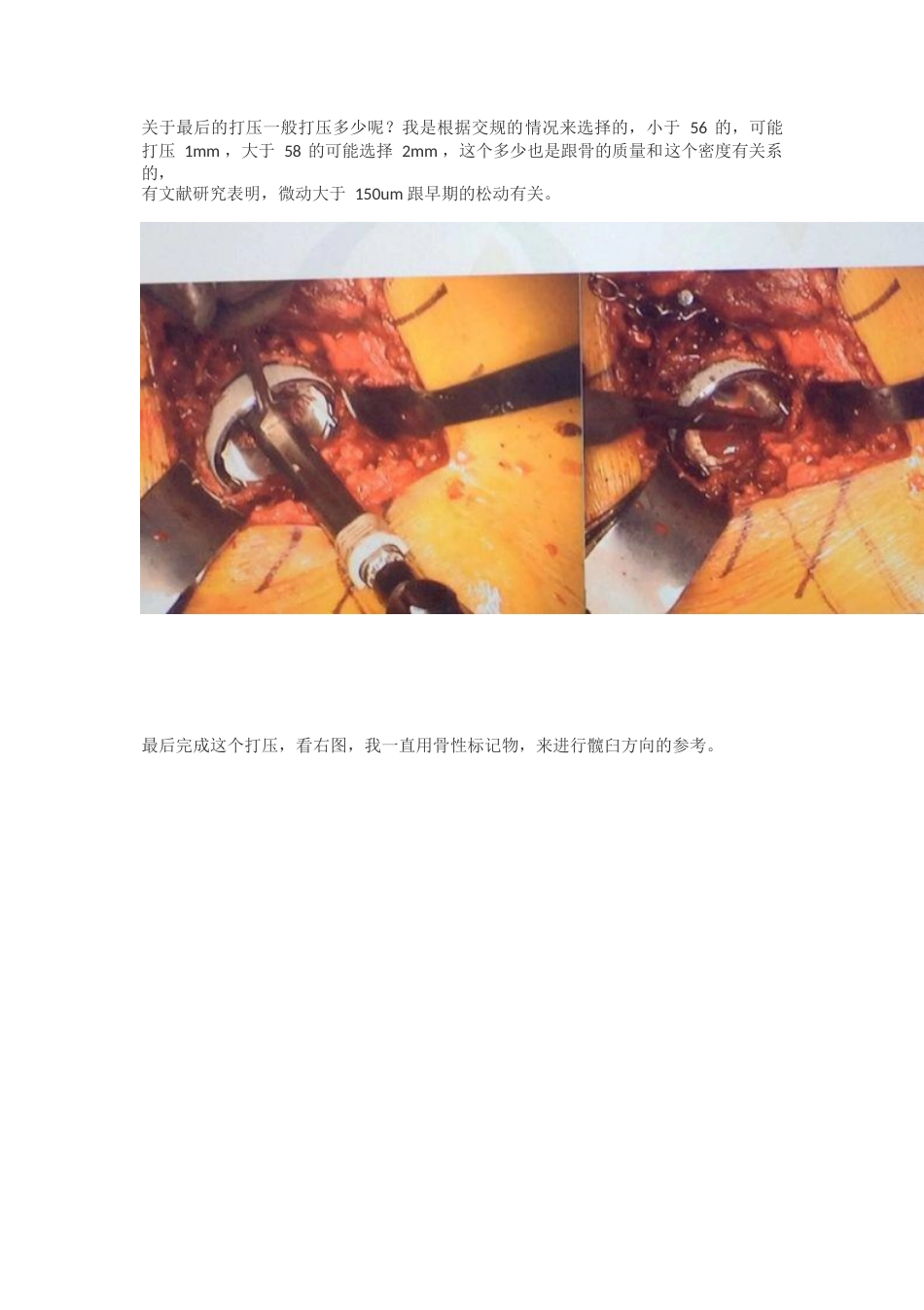 髋关节置换手术中如何做一个好的髋臼_第8页