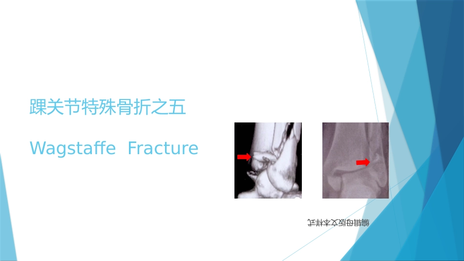 特殊类型的踝关节骨折（下）_第13页