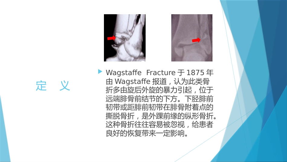 特殊类型的踝关节骨折（下）_第14页