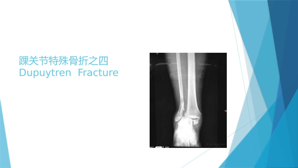 特殊类型的踝关节骨折（下）_第2页