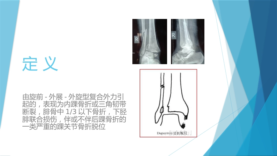 特殊类型的踝关节骨折（下）_第3页