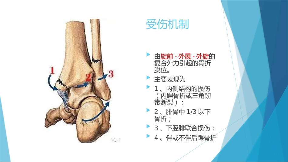 特殊类型的踝关节骨折（下）_第4页