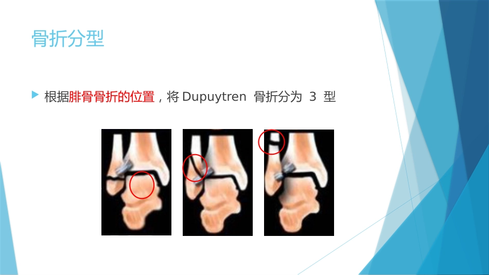 特殊类型的踝关节骨折（下）_第5页