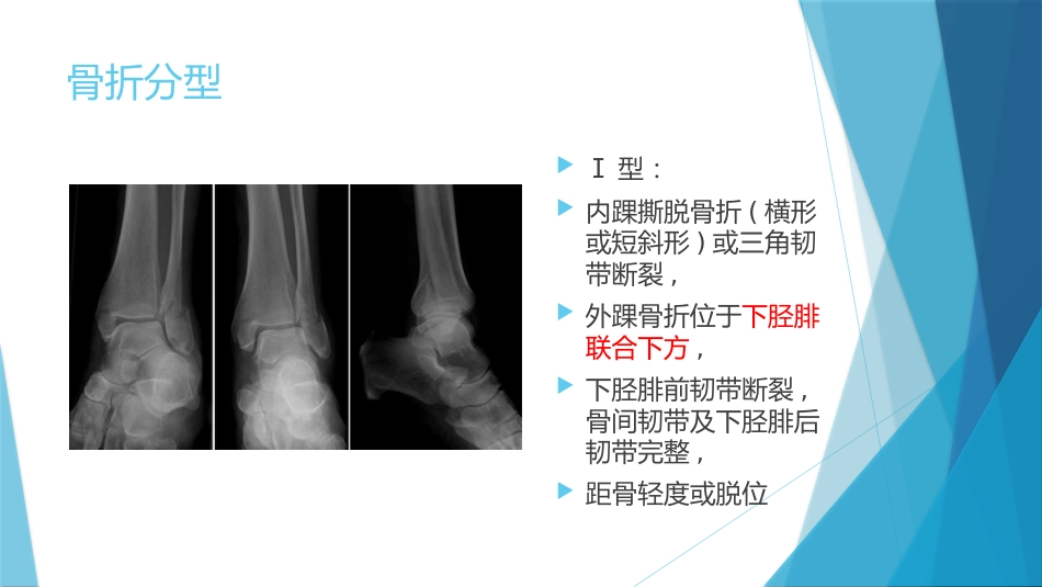 特殊类型的踝关节骨折（下）_第6页