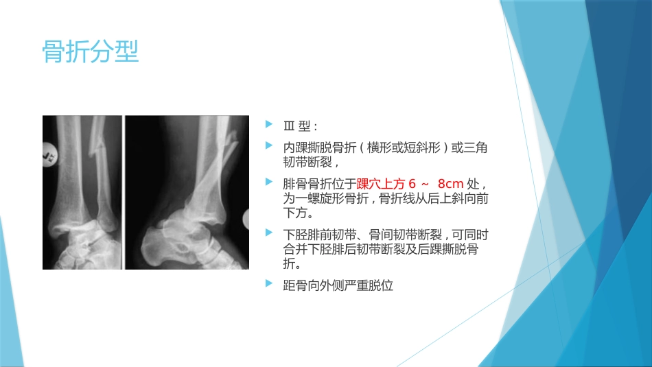 特殊类型的踝关节骨折（下）_第8页