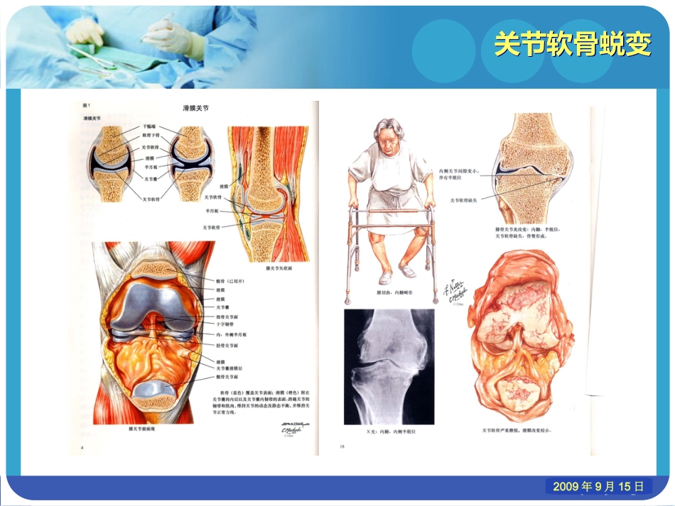 老年性骨性关节炎_第10页