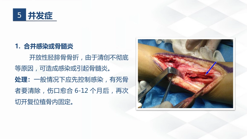 骨科-胫腓骨骨折教育查房_第9页