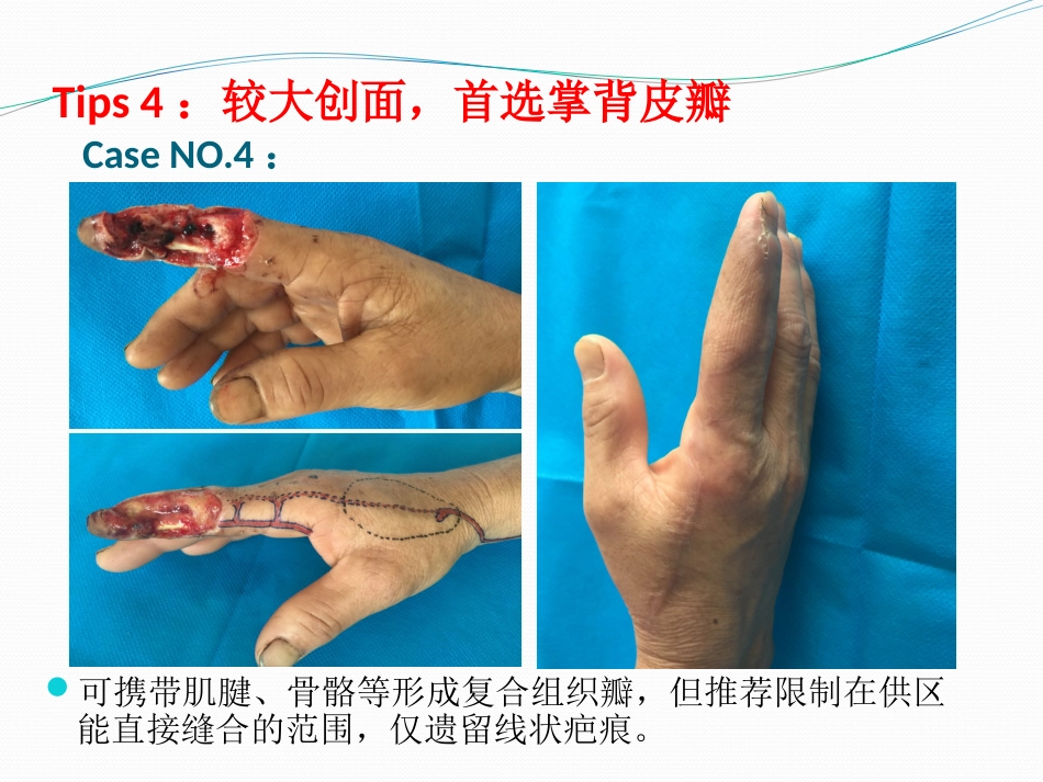 手指创面皮瓣修复的六项原则＆推荐建议_第7页