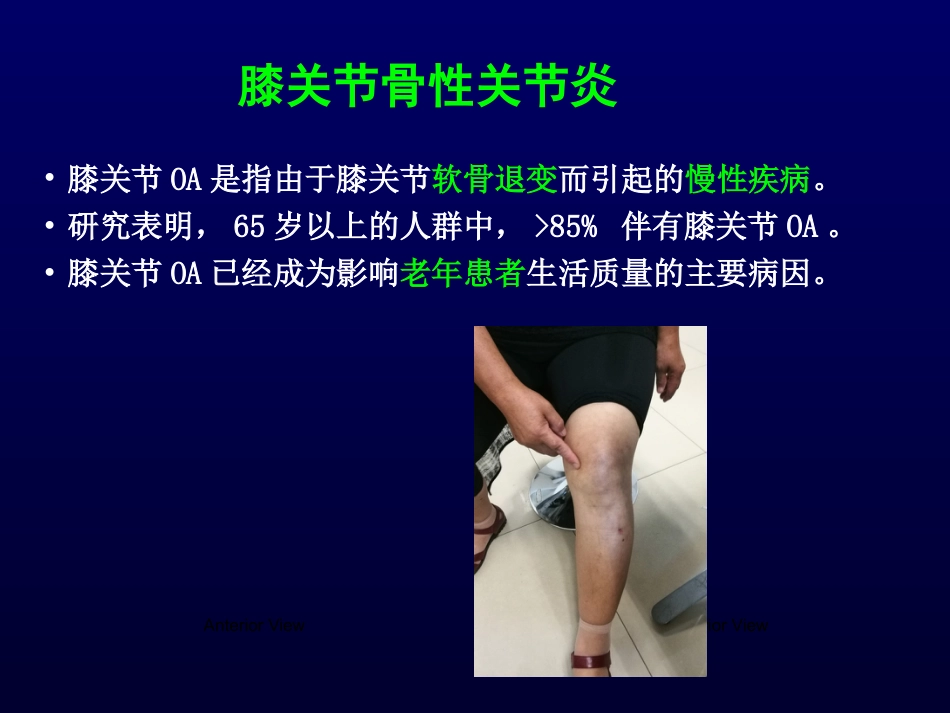单髁置换治疗膝关节OA的_第2页