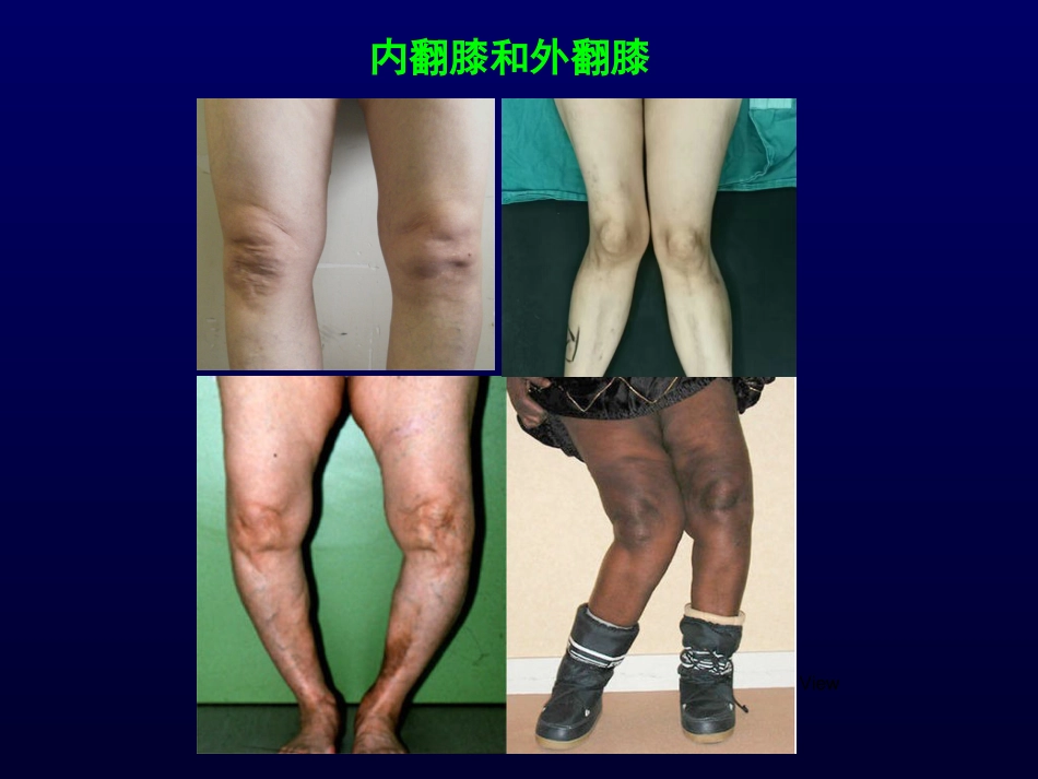 单髁置换治疗膝关节OA的_第3页