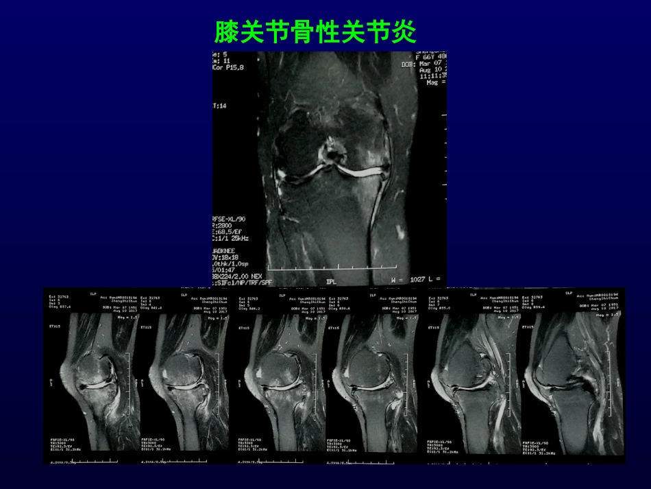 单髁置换治疗膝关节OA的_第9页