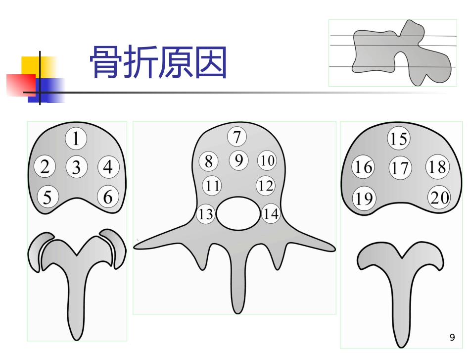 胸腰椎爆裂性骨折的治疗_第9页